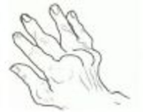 Managing Rheumatoid Arthritis: An Overview of New Research