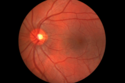 Faricimab Found to Improve Vision for Patients with Retinal Vein Occlusion 