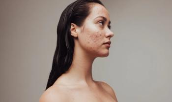 Stress and depression due to skin problems - Image credit: Jacob Lund | stock.adobe.com