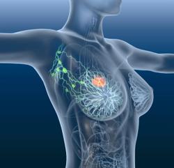 Radius, Menarini Submit NDA for Elacestrant as Treatment of ER+/HER2- Breast Cancer
