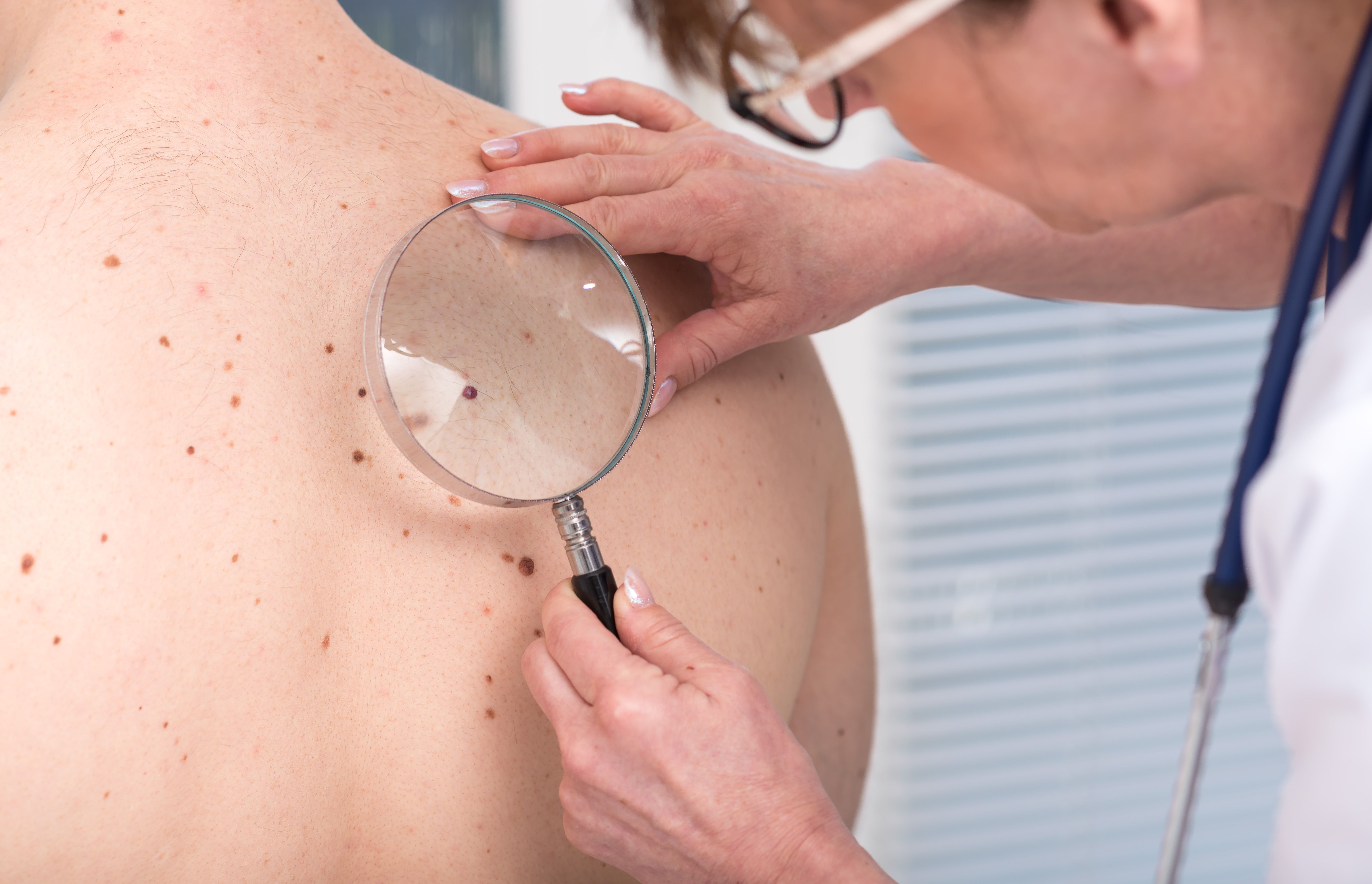 After 2 CRLs, FDA Approves Vusolimogene Oderparepvec With Nivolumab for Advanced Melanoma