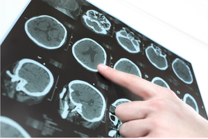 Clinical Updates, Awareness Efforts During Parkinson's Awareness Month