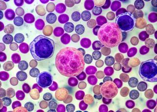 Magnified bone marrow biopsy showing plasma cells with irregular nuclei and multiple myeloma tumor cells infiltrating normal hematopoietic tissue.
