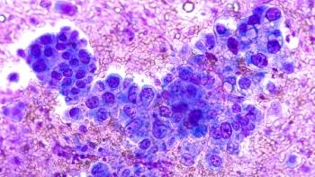 Phogomicrograph of fine needle aspiration (FNA) cytology of a pulmonary (lung) nodule showing adenocarcinoma | Image Credit: David A Litman - stock.adobe.com