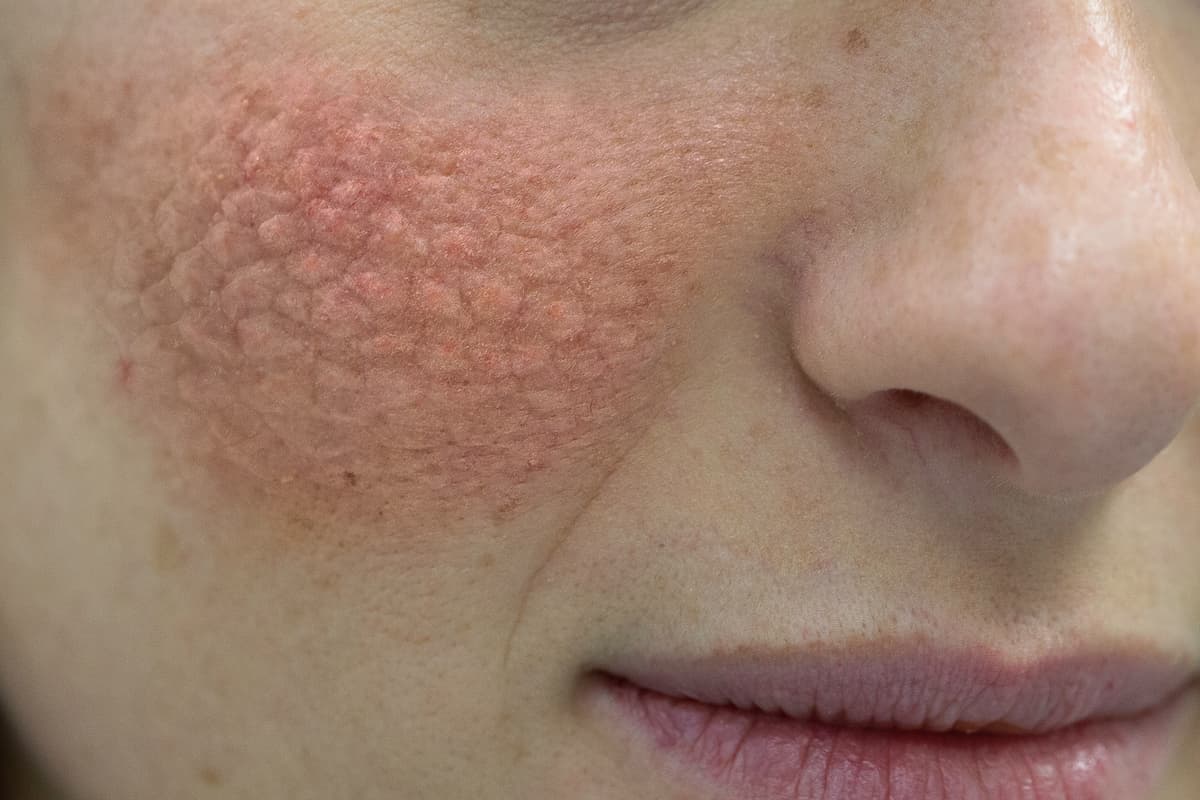 close up of young caucasian women face with red cheeks that cause skin problems