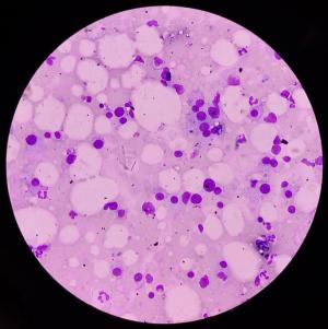 Multiple myeloma -- Image credit: MdBabul | stock.adobe.com