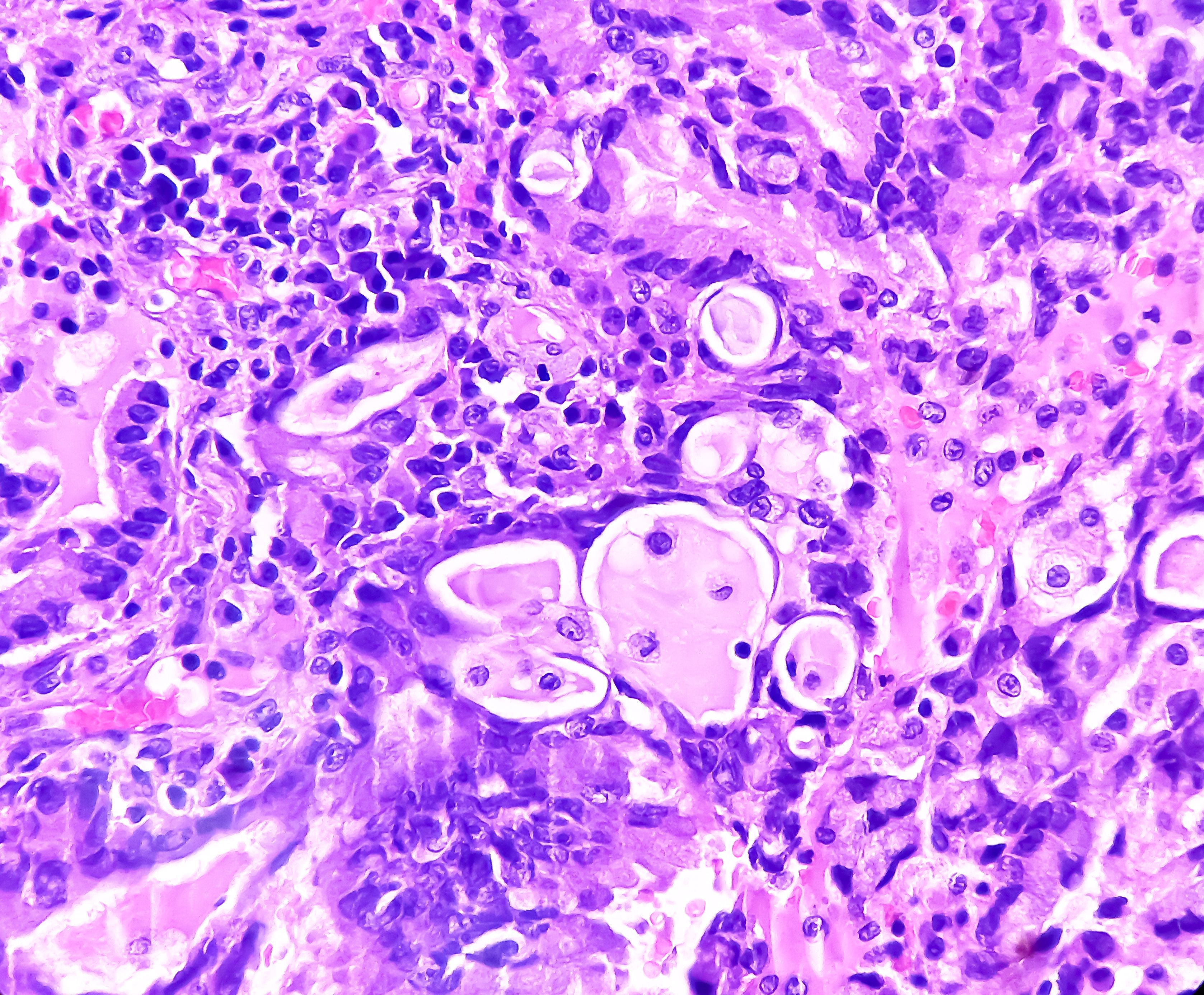Lung adenocarcinoma -- Image credit: MdBabul | stock.adobe.com 