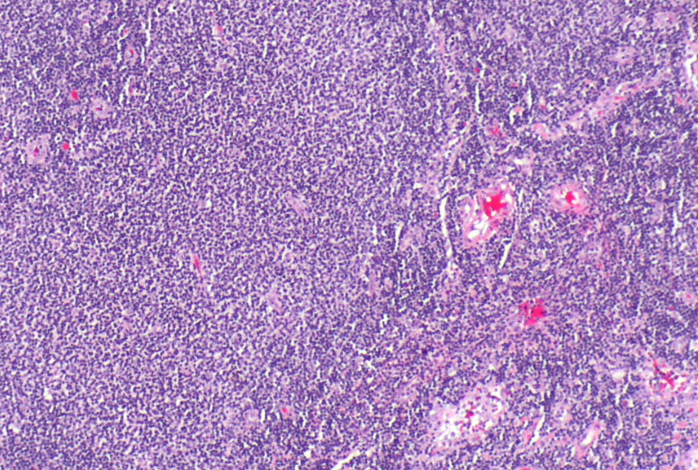 BLA Submitted For Epcoritamab For The Treatment Of Relapsed/Refractory ...