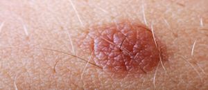 New Skin Cancer Treatments Show Promise
