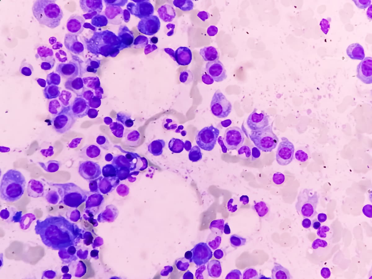Microscopic view of bone marrow slide feature are suggestive Multiple myeloma, also known as myeloma, is a type of bone marrow cancer.