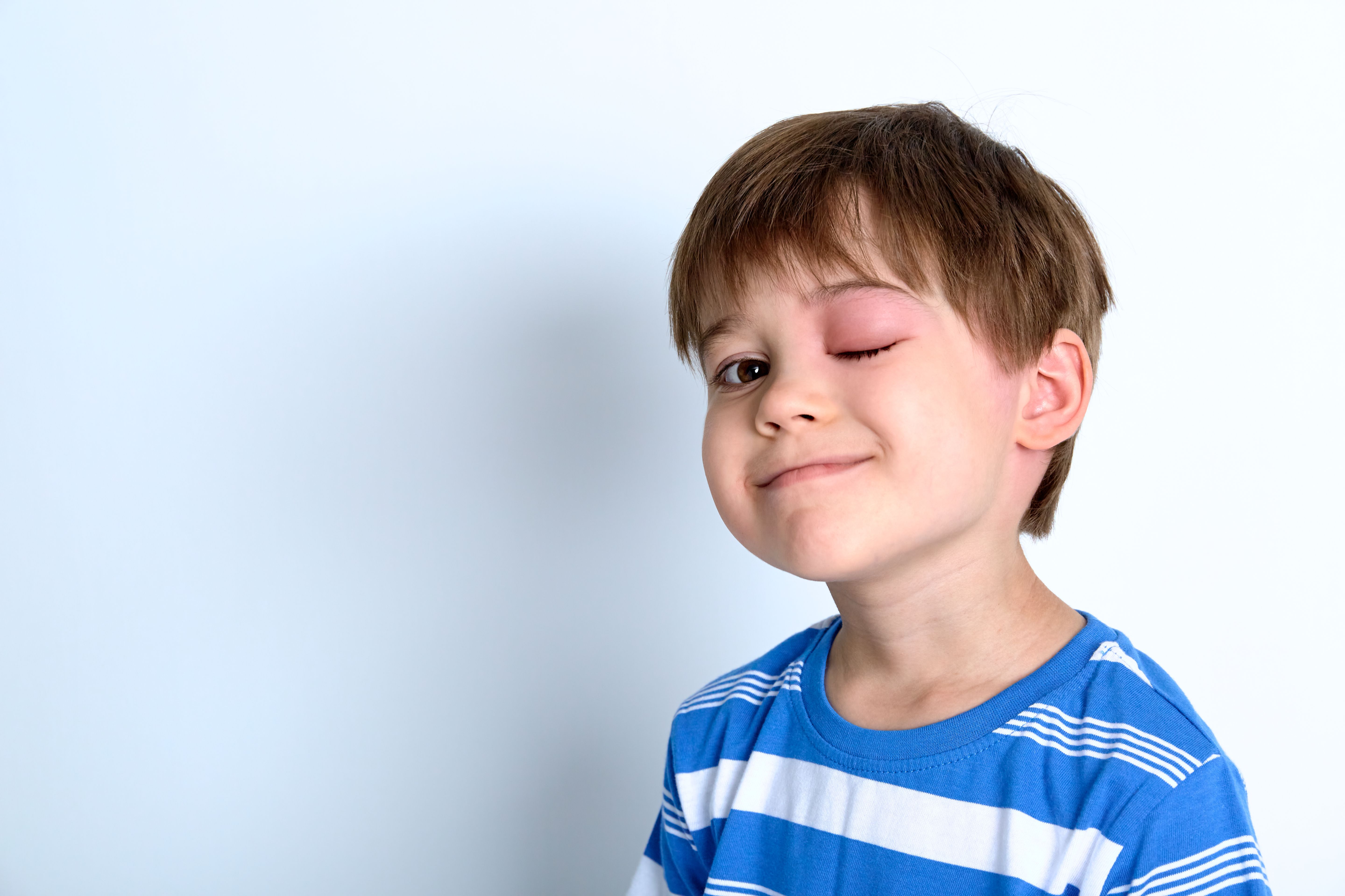 Portrait of child looking at the camera with swollen eye. Image Credit: © Hanna - stock.adobe.com