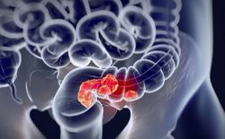 Managing Refractory Metastatic Colorectal Cancer With Fruquintinib