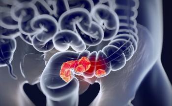 Managing Refractory Metastatic Colorectal Cancer With Fruquintinib