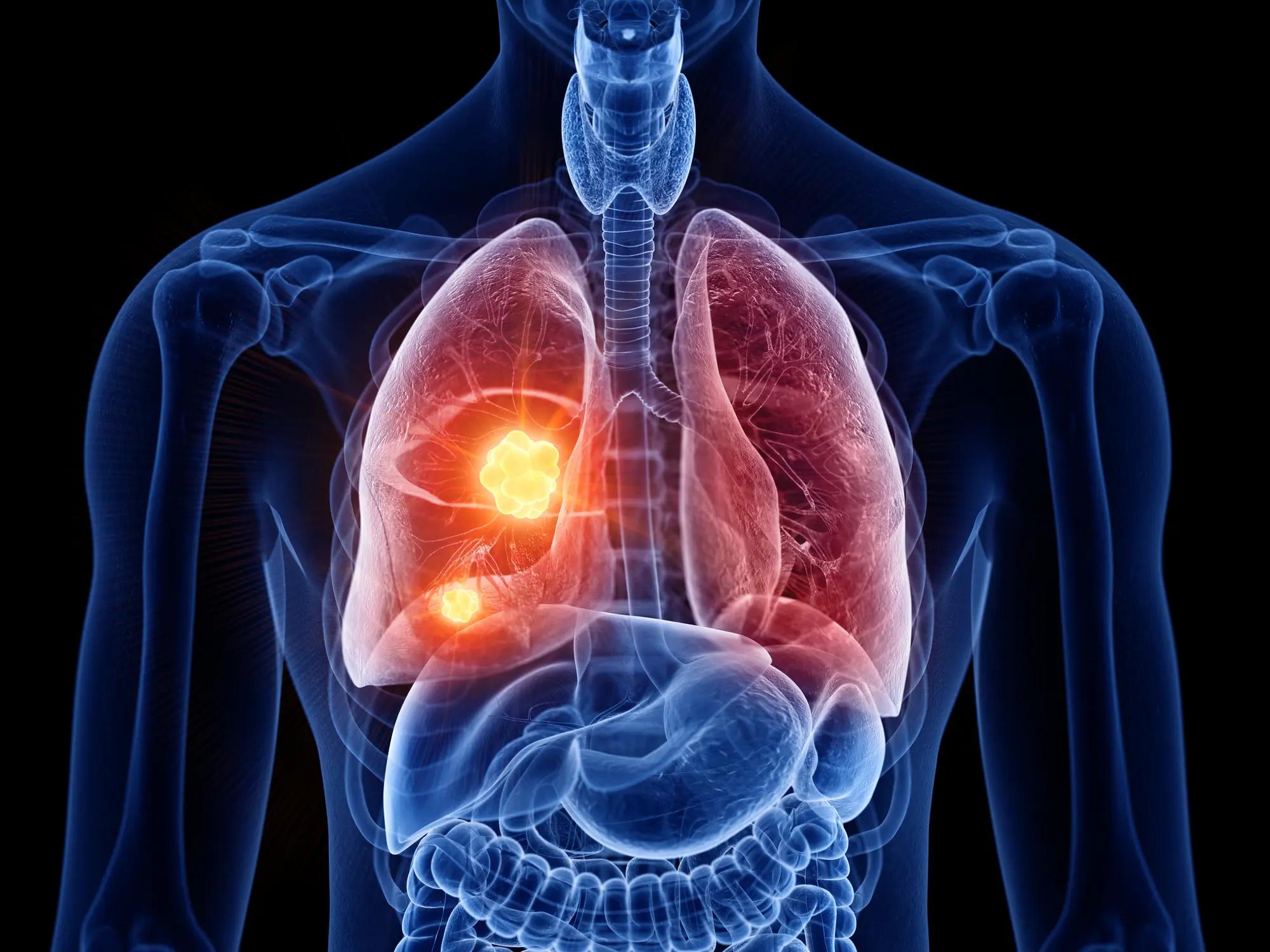 New ROS1+ Lung Cancer Drug Shows Positive Results for Over Half of Patients