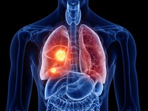 New ROS1+ Lung Cancer Drug Shows Positive Results for Over Half of Patients