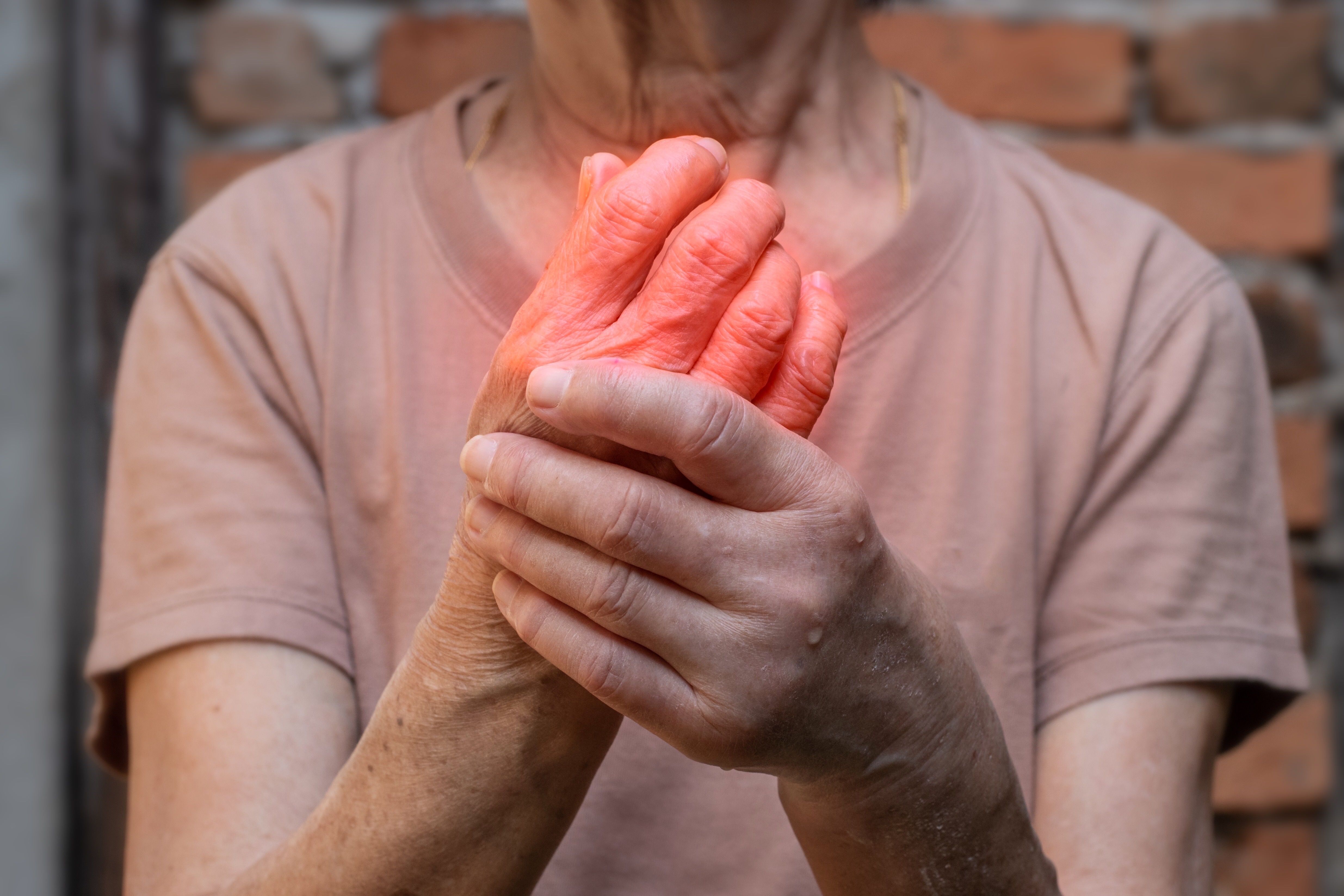 Hand joints inflammation. Concept of rheumatic arthritis, rheumatism, gout, joint swelling or arthralgia - Image credit: ZAY WIN HTAI | stock.adobe.com