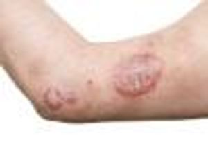 Are Older TNF Inhibitors More Effective at Treating Psoriatic Arthritis Than Newer Drugs?