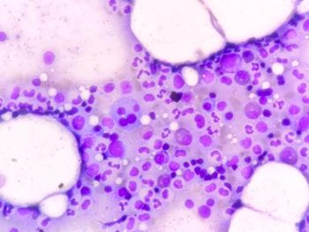 Bone marrow study: Plasma cell dyscrasia. Smoldering or early multiple myeloma (the patient has a history of plasmacytoma at the dorsal vertebral level | Image Credit: © Saiful52 - stock.adobe.com