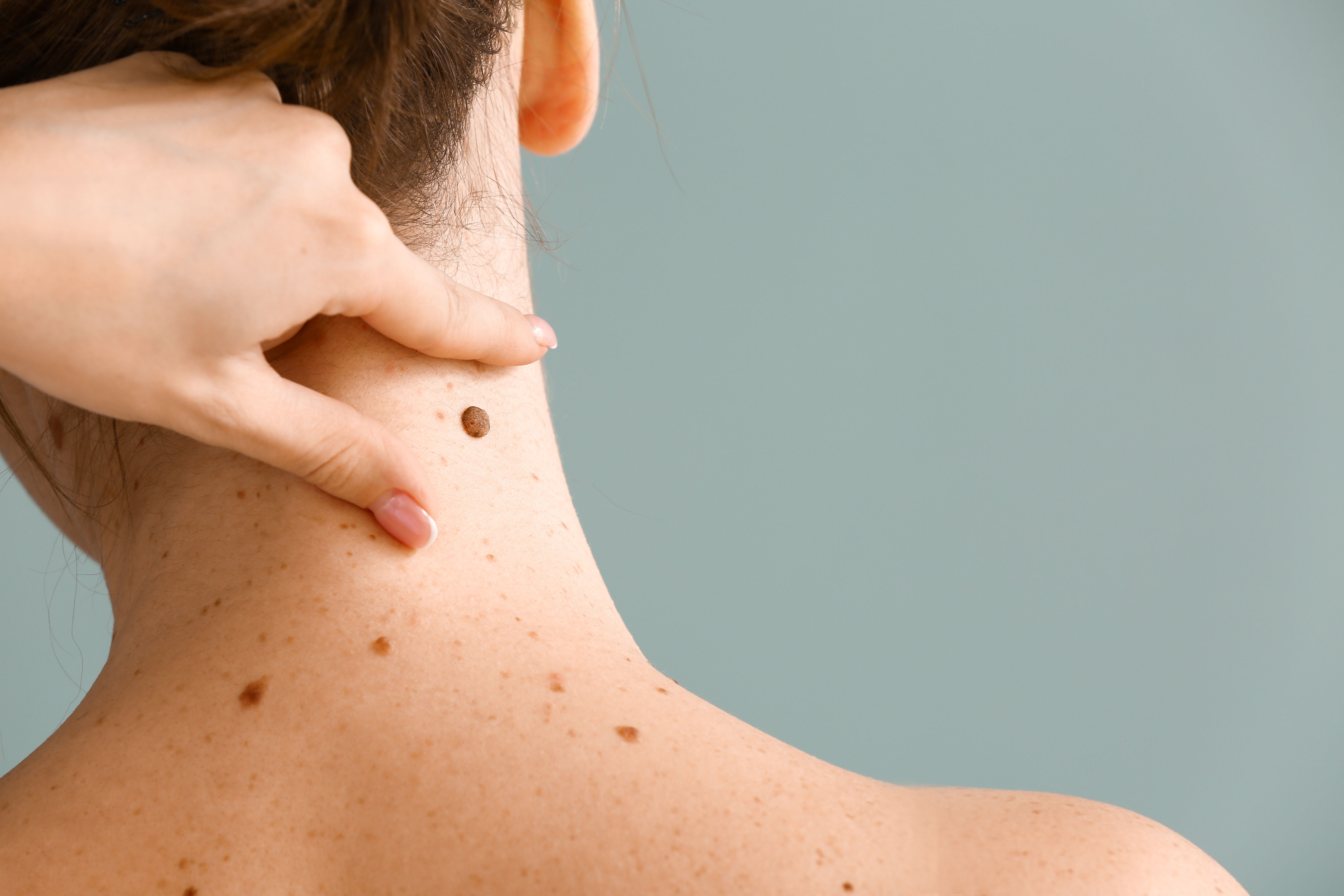 Dermatologist examining mole