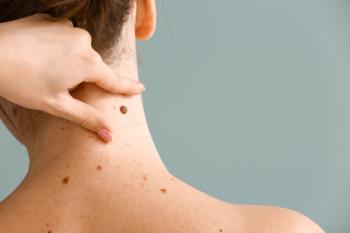 Dermatologist examining mole