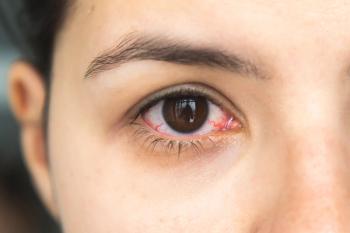 Patient with dry eye disease -- Image credit: Evgeniya Primavera | stock.adobe.com