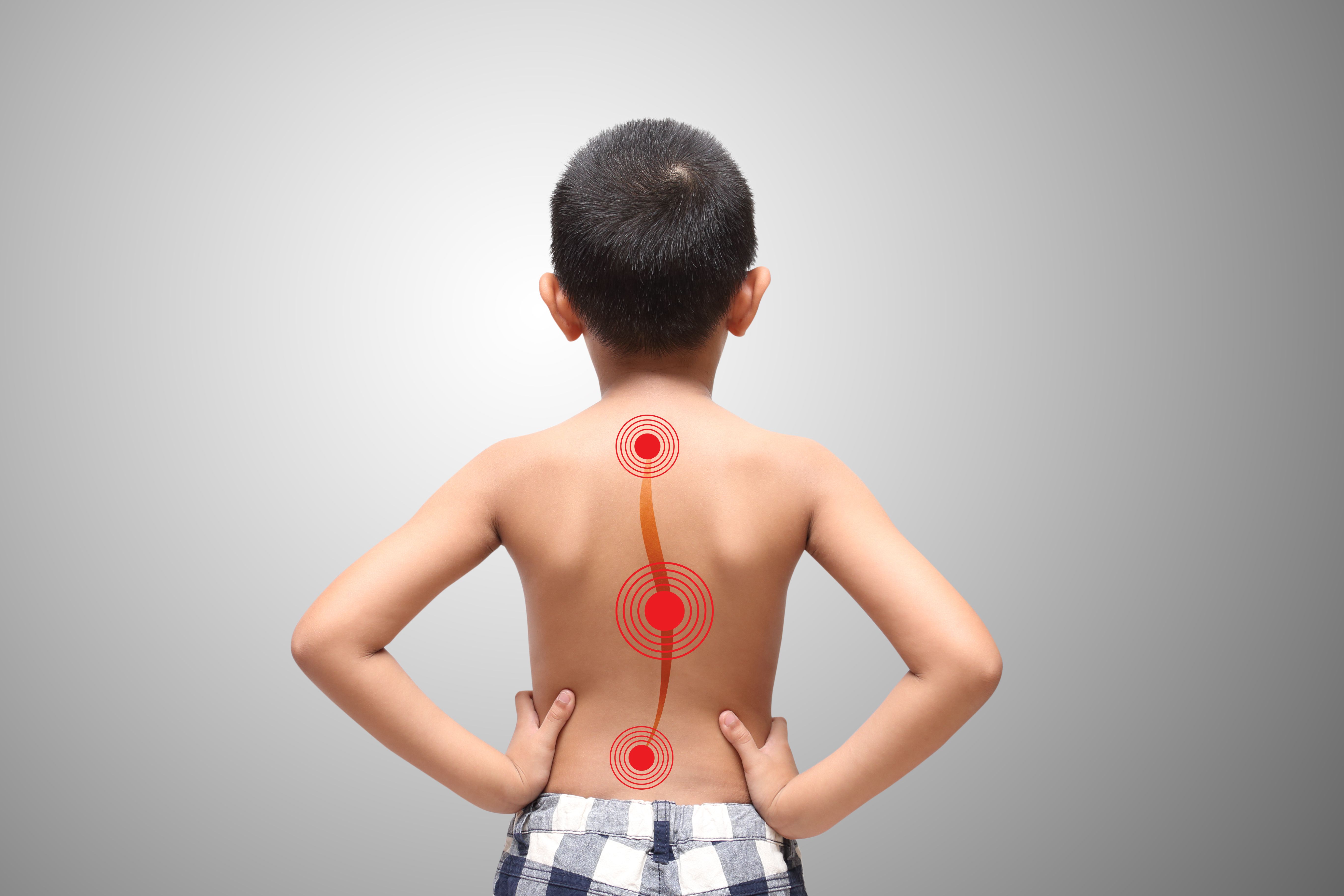 Kid with scoliosis, isolated on white background - Image credit: Jeffy1139 | stock.adobe.com