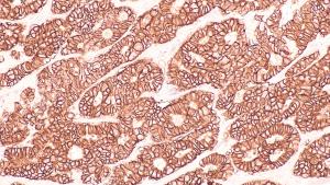 HER2 breast cancer -- Image credit: David A Litman | stock.adobe.com