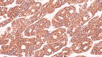 HER2 breast cancer -- Image credit: David A Litman | stock.adobe.com