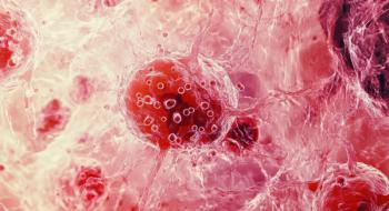 Photomicrograph of Diffuse Large B-Cell Lymphoma | Image Credit: © Maryna - stock.adobe.com