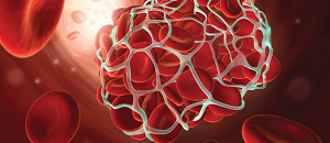 Protein S Deficiency