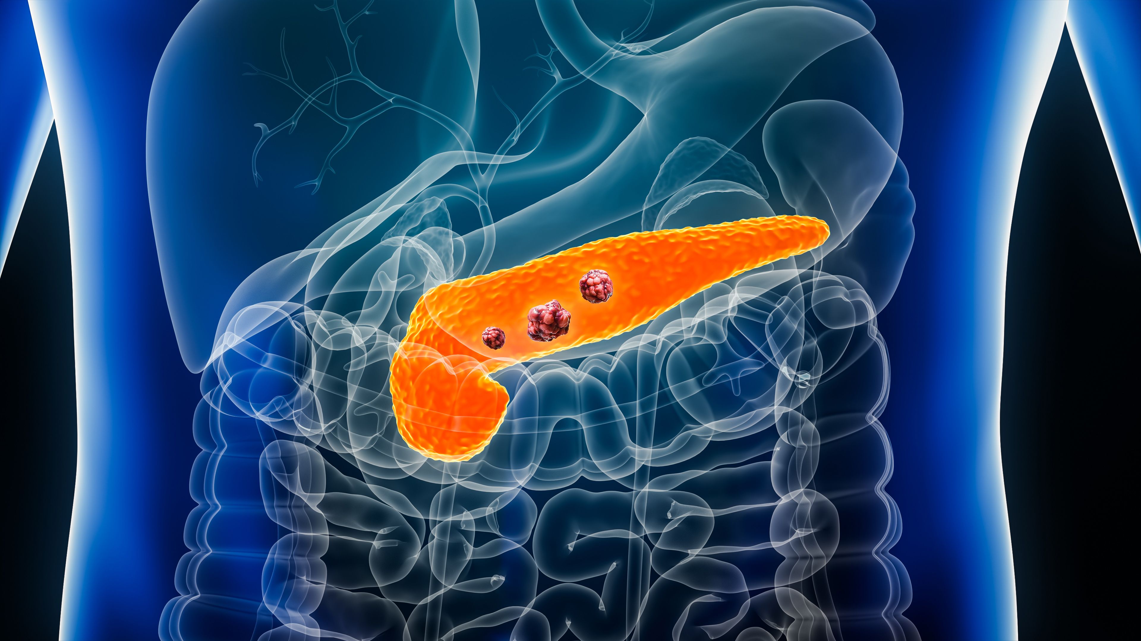 Pancreas or pancreatic cancer with organs and tumors or cancerous cells 3D rendering illustration with male body. Anatomy, oncology, disease, medical, biology, science, healthcare concepts- Image credit: Matthieu | stock.adobe.com