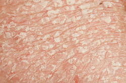 Psoriasis With Coexistent Lupus Erythematosus Rare, Mainly Impacts Women