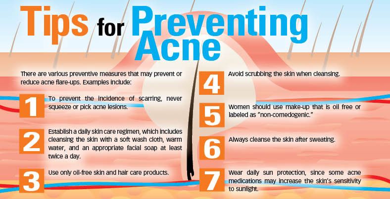 steroid acne cream