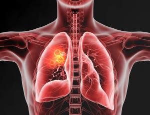 X-ray image of lung cancer -- Image credit: Axel Kock | stock.adobe.com