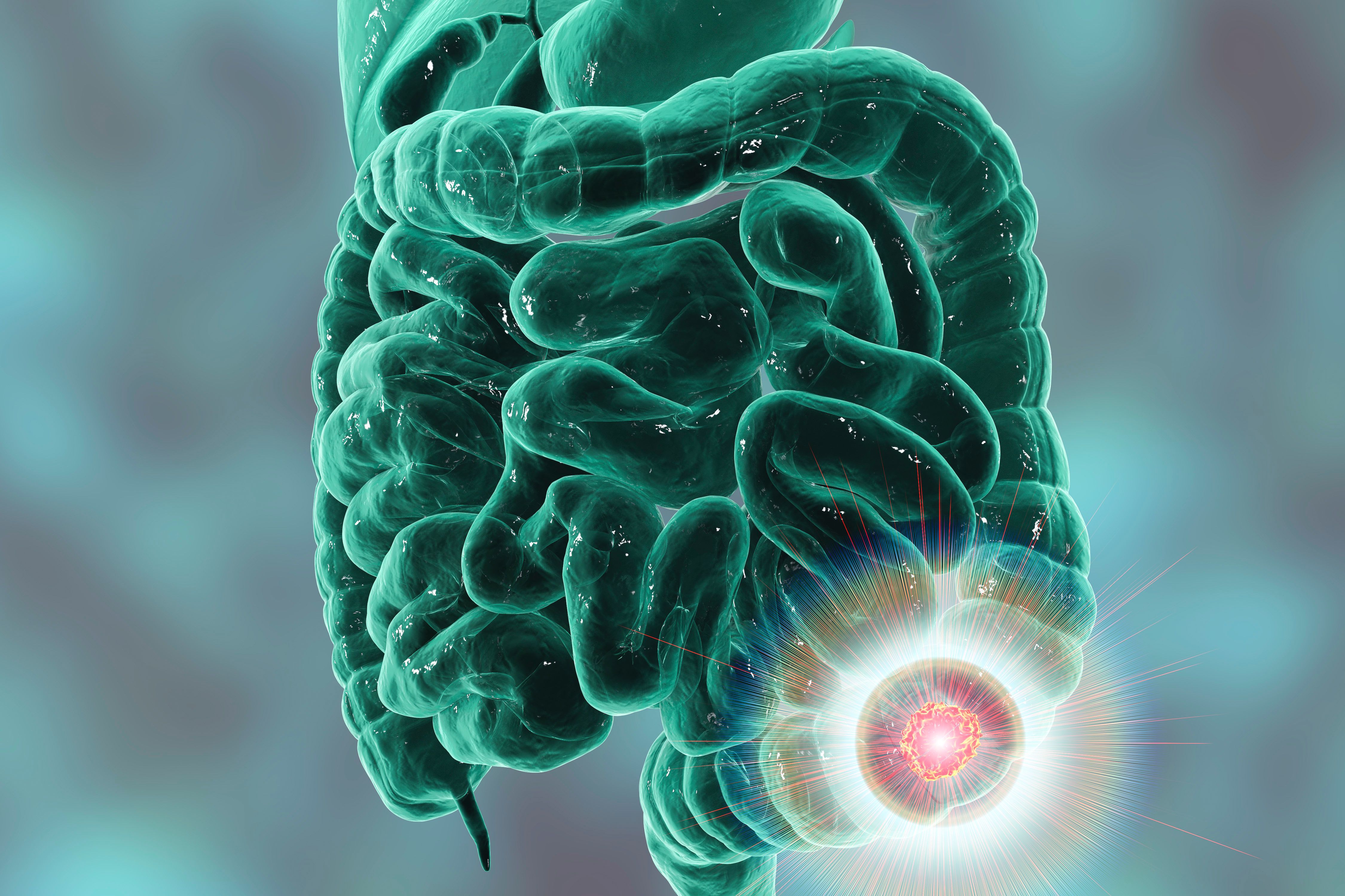 3D medical illustration of colorectal cancer | Image Credit: © Dr_Microbe - stock.adobe.com