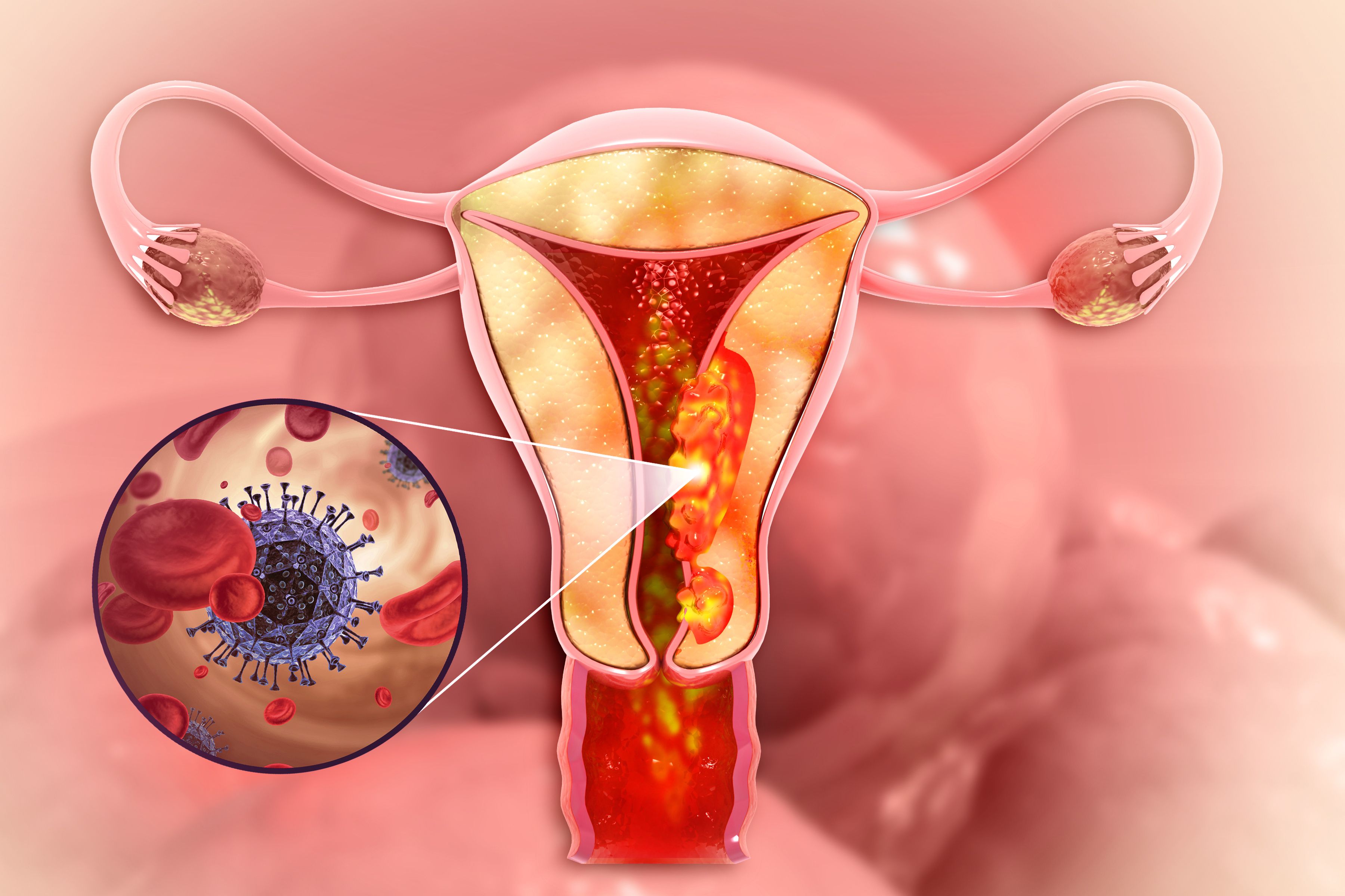 Endometrial cancer -- Image credit: Crystal light | stock.adobe.com