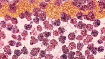 Diffuse large B cell lymphoma (DLBCL) -- Image credit: SuriyaPhoto | stock.adobe.com