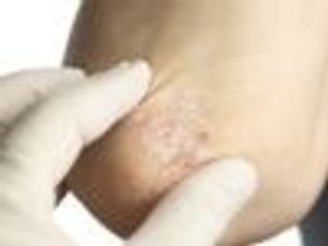 Psoriasis and Psoriatic Arthritis Patient Care: What Pharmacists Should Know