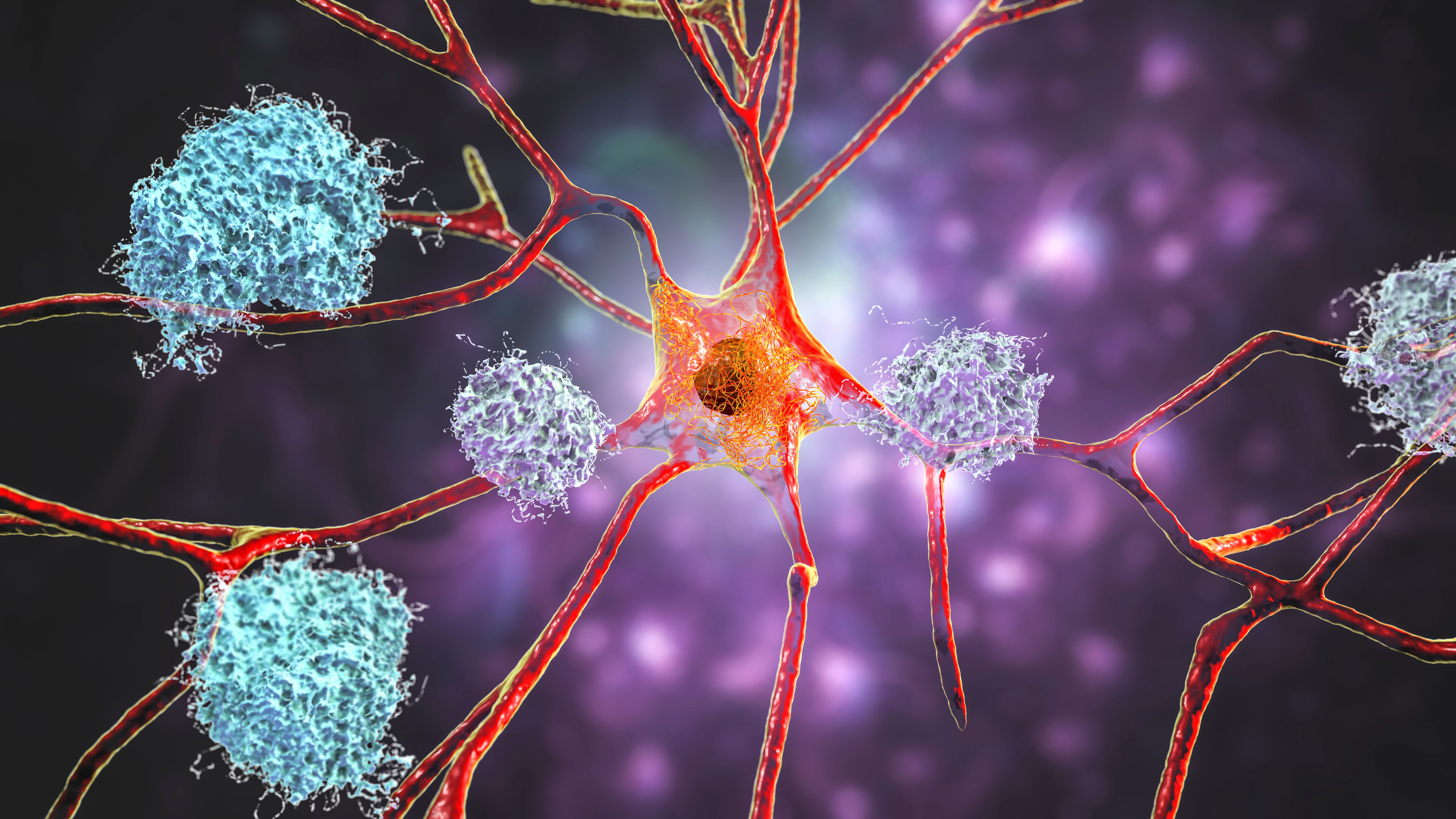 Depiction of plaque build up on neurons within brain -- image credit: Dr_Microbe | stock.adobe.com