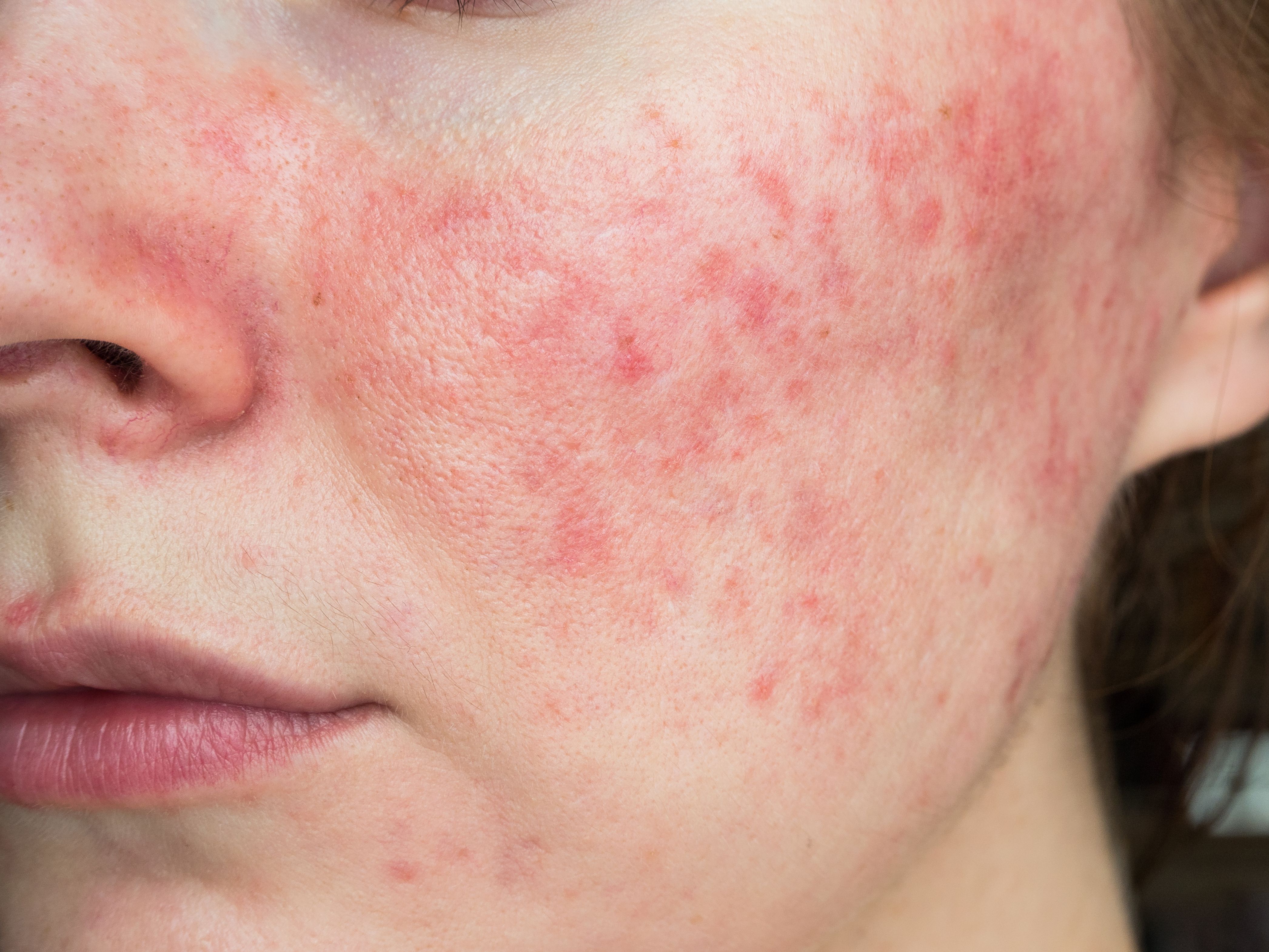 papulopustular rosacea, close-up of the patient's cheek Image credit: Shauerman | stock.adobe.com