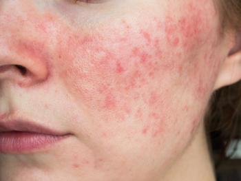papulopustular rosacea, close-up of the patient's cheek Image credit: Shauerman | stock.adobe.com