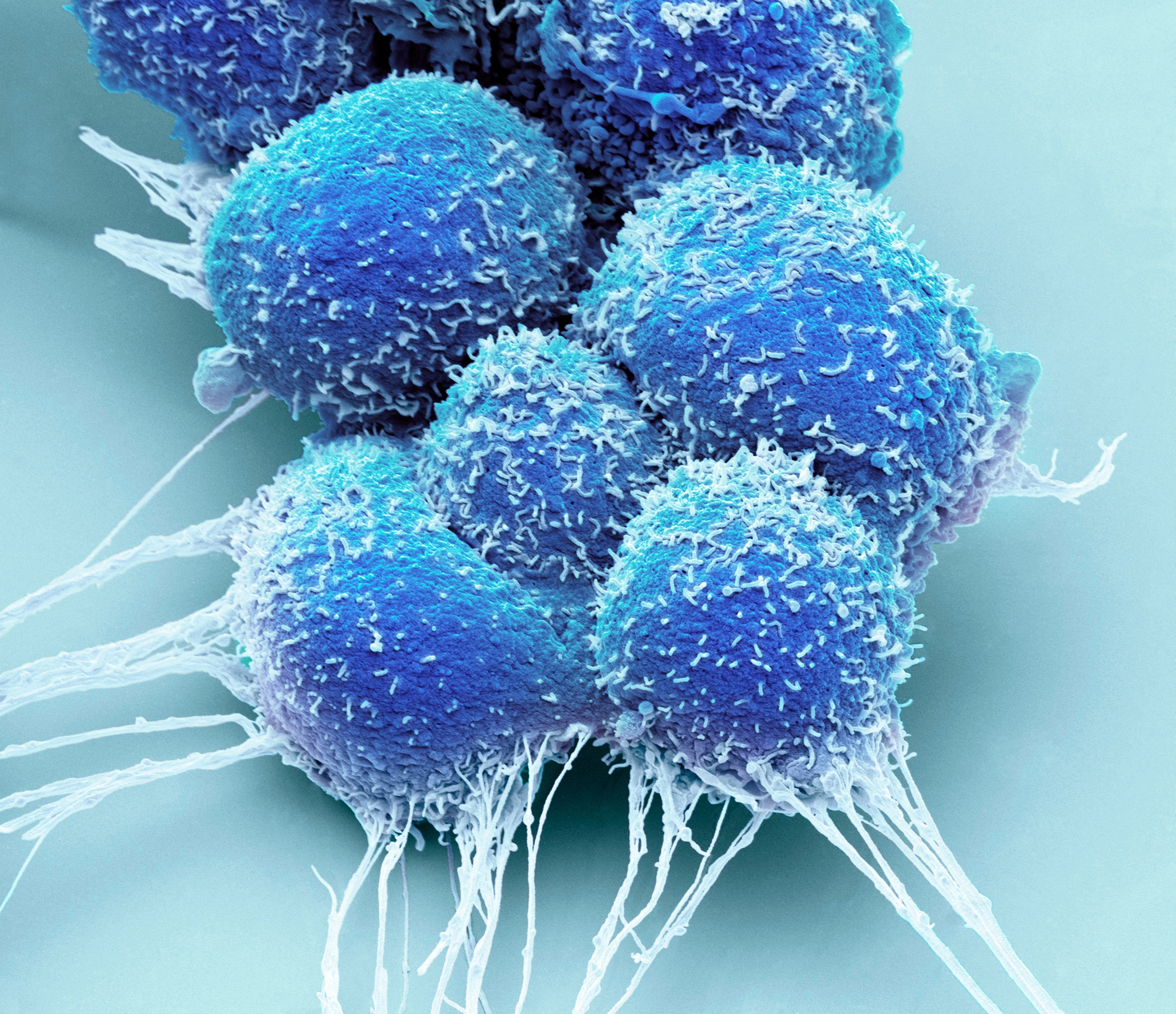 Close up of prostate cancer cells - Image credit: Science RF | stock.adobe.com