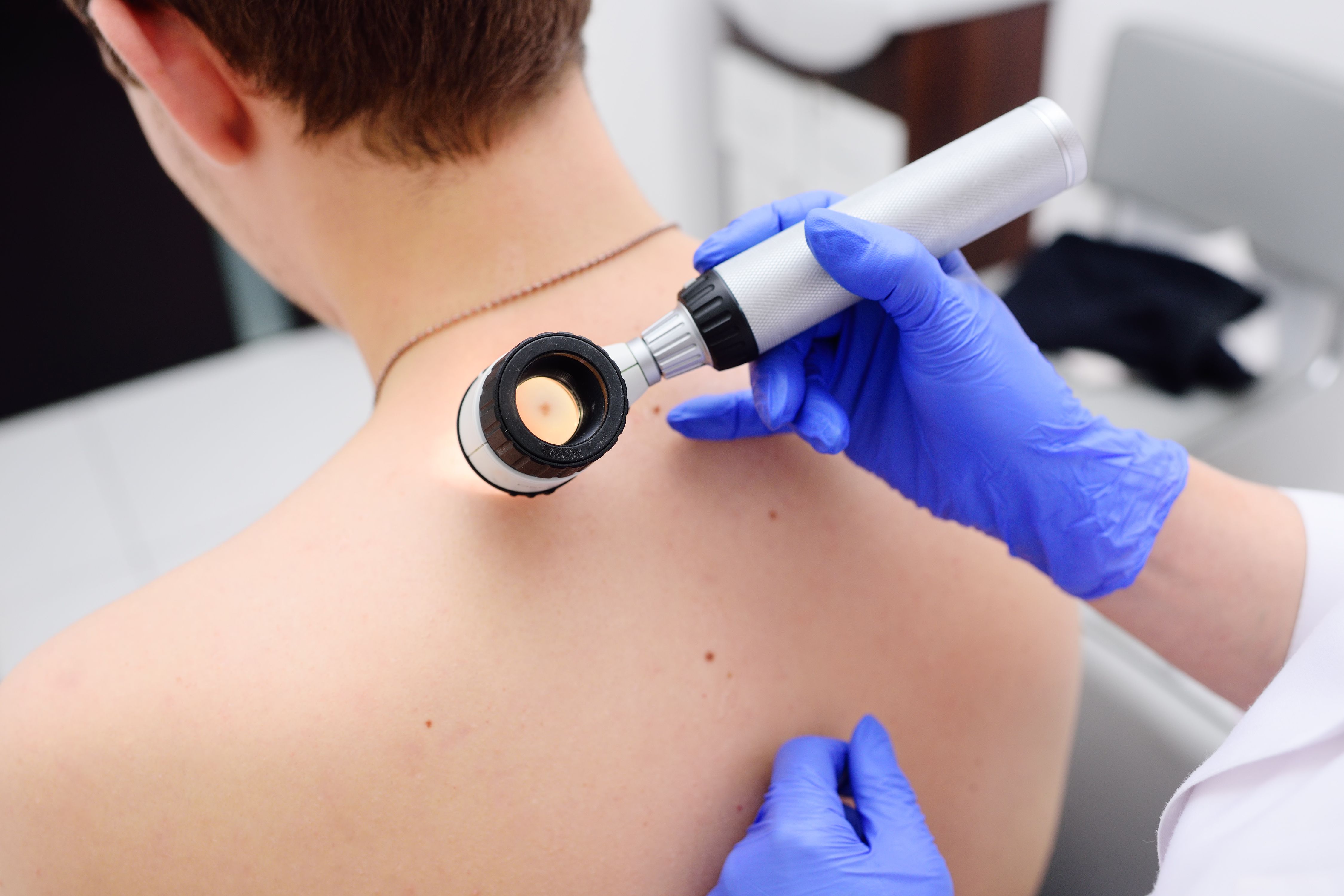 Physician checking patient for skin cancer
