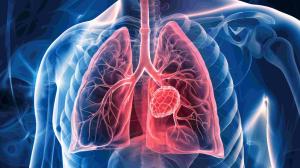 Tarlatamab Plus Durvalumab Improves Survival in First-Line ES-SCLC
