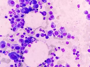 Microscopic view of bone marrow, multiple myeloma