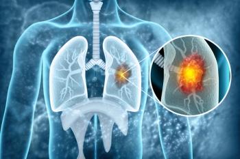 Non–small cell lung cancer (NSCLC) -- Image credit: Crystal light | stock.adobe.com