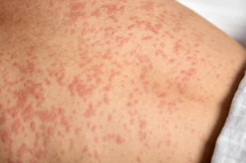 Patient with systemic mastocytosis (SM) -- Image credit: Aleksandr | stock.adobe.com