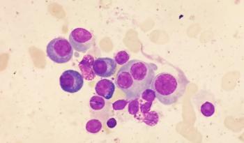 Microscopic view of bone marrow slide showing multiple myeloma | Image credit: Saiful52 | stock.adobe.com