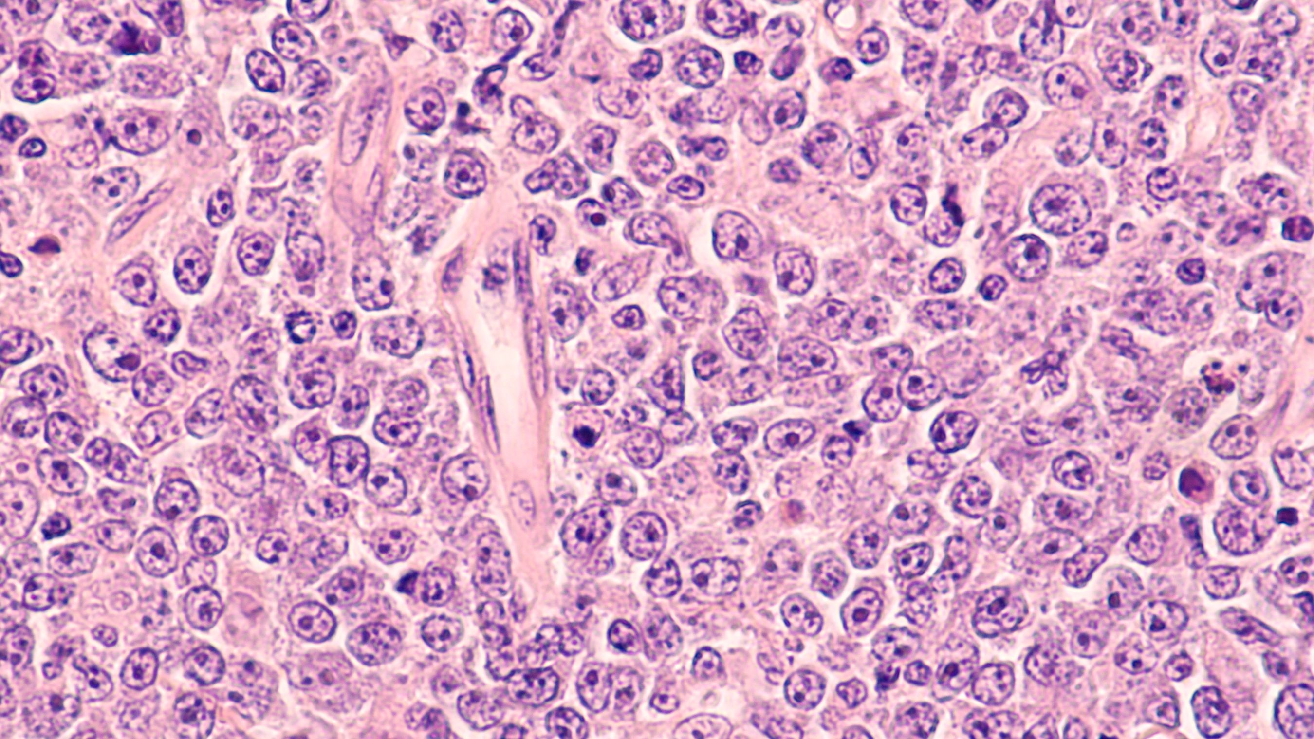 Lymphoma awareness: photomicrograph of a diffuse large B-cell lymphoma (DLBCL) a type of non-Hodgkin lymphoma. This case is from the testis of an elderly man and shows prominent nucleoli. Credit: David A Litman - stock.adobe.com.