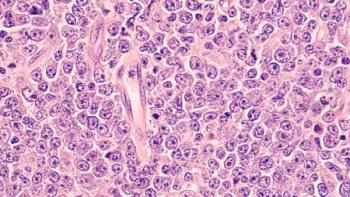 Lymphoma awareness: photomicrograph of a diffuse large B-cell lymphoma (DLBCL) a type of non-Hodgkin lymphoma. This case is from the testis of an elderly man and shows prominent nucleoli. Credit: David A Litman - stock.adobe.com.